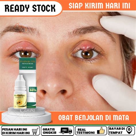 Jual Obat Penghilang Benjolan Di Kelopak Mata Salep Mata Bintitan