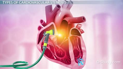 What Is Stenosis Definition Types And Symptoms Lesson