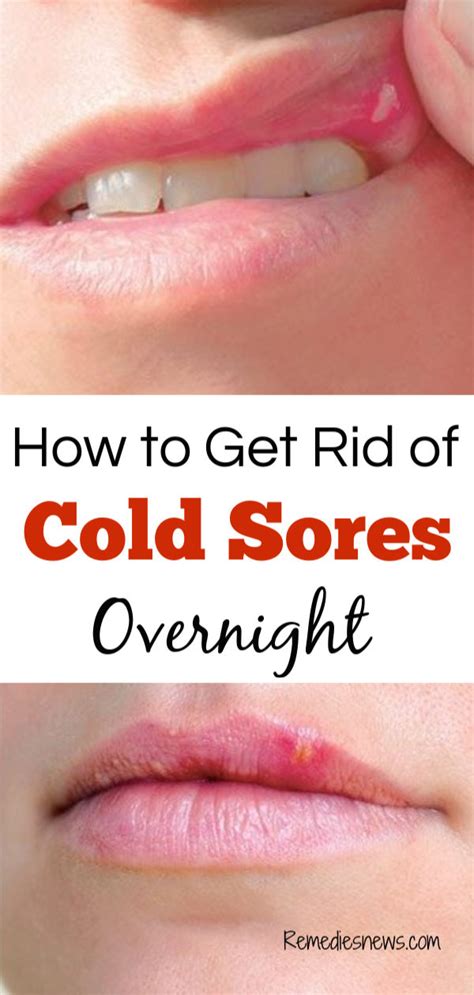 How To Get Rid Of Cold Sores Fast 11 Best Home Remedies