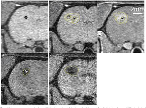 Figure 1 From Histologic Distribution And Characteristics On Mr Imaging