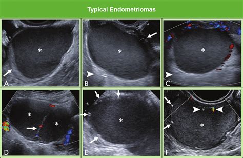 Images Show Typical Endometriomas A Common Appearance Of Endometrioma