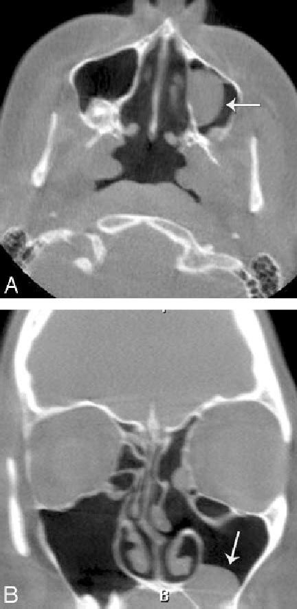 [pdf] Ruptured Maxillary Retention Cyst Cause Of Unilateral Rhinorrhea