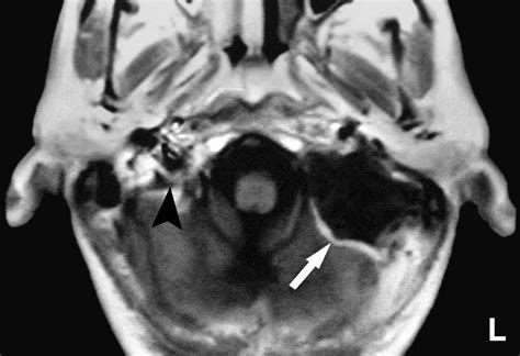 Axial T1-weighted MRI, showing the right jugular foramen (arrow head ...