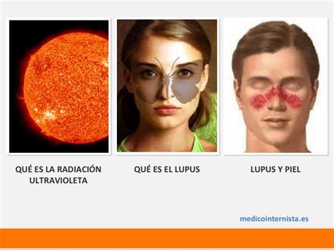 Sol y lupus eritematoso Médico Internista Medicina Interna