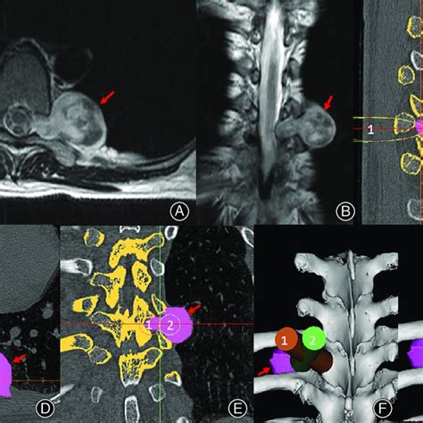 Preoperative T Weighted Mri On Axial A And Coronal B Planes