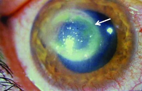 Acanthamoeba Keratitis Causes Signs Symptoms Diagnosis Treatment And Prognosis