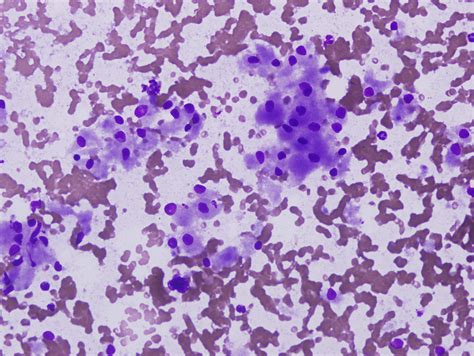 Pathology Outlines Granular Cell Tumor