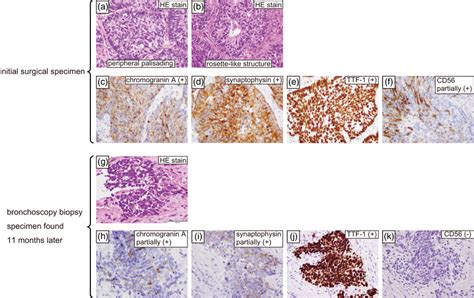 Microscopic Hematoxylin Eosin Staining And Immunohistochemical