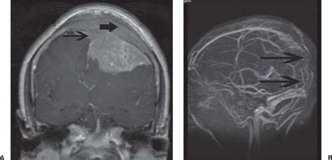 13 Modern Imaging Techniques For Meningiomas Neupsy Key