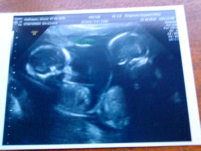 Identical Twins Ultrasound 20 Weeks