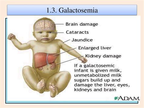 PPT Inborn Errors Of Metabolism IEM Lecture 2 PowerPoint