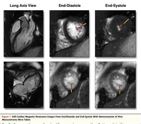 Figure 1 From Comparison Of Systolic And Diastolic Criteria For