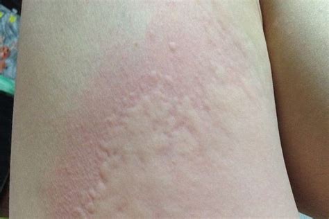 Che cos è l orticaria Il ruolo dell istamina e come intervenire