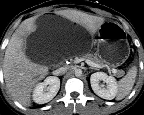 Liver Atlas Case 307 Laceration