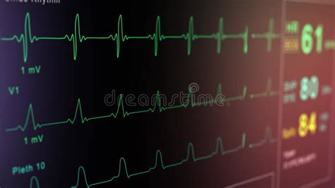 Monitor De Paciente Muestra Signos Vitales Ecg Electrocardiograma Ekg