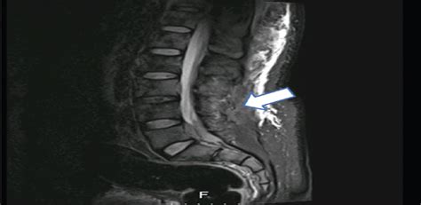 Acute Myeloid Leukemia With Acute Spinal Cord Compression As