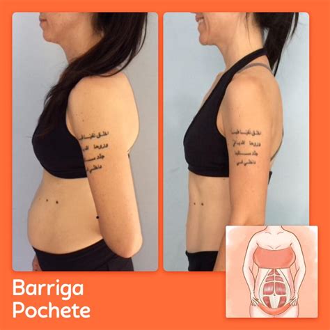 Tipos De Barriga X Tipos De Di Stase