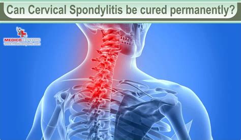 Answered Can Cervical Spondylosis Be Cured