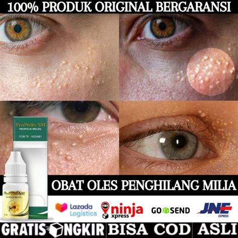 Obat Oles Penghilang Milia Di Wajah Bintik Putih Kelopak Mata Hidung