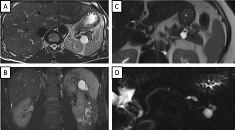 Comparison Of Lymphoepithelial Cyst LEC And Branch Duct Intraductal