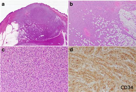 Histological Appearance Of Classic Dermatofibrosarcoma Protuberans