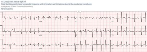 The Ecg In Fever And Infectious Disease Ecg Cases