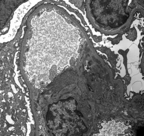 Ajkd Atlas Of Renal Pathology Subacute Bacterial Endocarditisassociated Glomerulonephritis