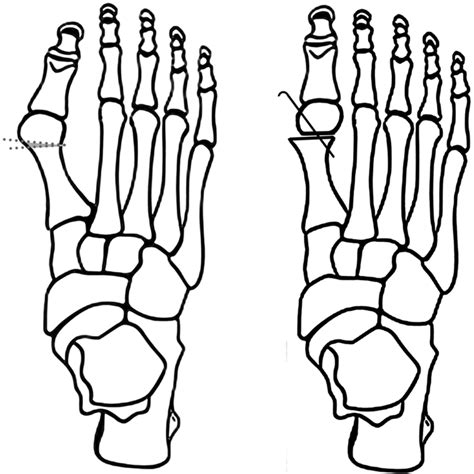 Long Term Results Of The Hohmann And Lapidus Procedure For The