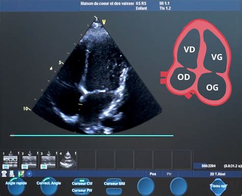 Chographie Cardiaque D Effort La Maison Du C Ur Et Des Vaisseaux