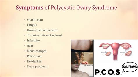 Ppt Polycystic Ovary Syndrome Pcos Powerpoint Presentation Free