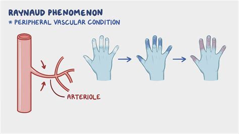 Raynaud phenomenon: Nursing - Osmosis Video Library