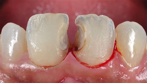 dental restoration hernandez dental implant center