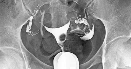 Submucosal Uterine Leiomyoma Radiology Reference Article