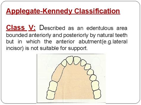 Classification Of Partially Edentulous Arches Requirements Of An