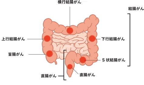 大腸がんについて ｜ 富山西総合病院｜富山西リハビリテーション病院