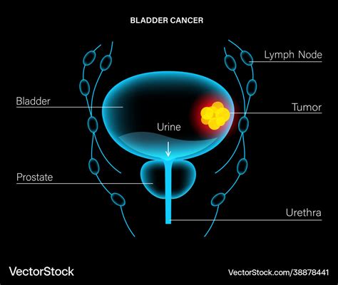 Bladder cancer stages Royalty Free Vector Image