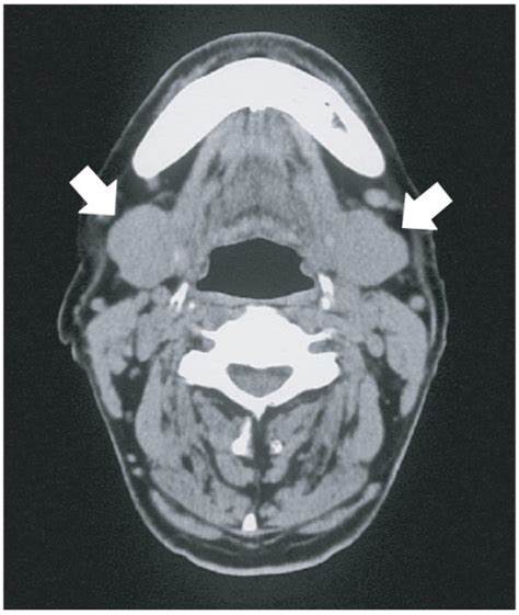 Kuttners Tumor Kuttners Sykdom Küttners Spyttkjertelsvulst