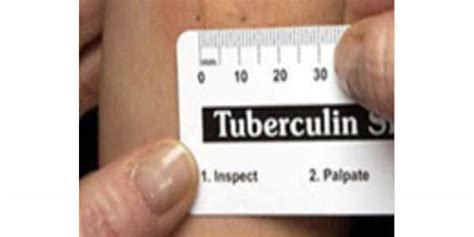 Mantoux Tuberculin Skin Testing Ruler Tuberculosis Tb Cdc