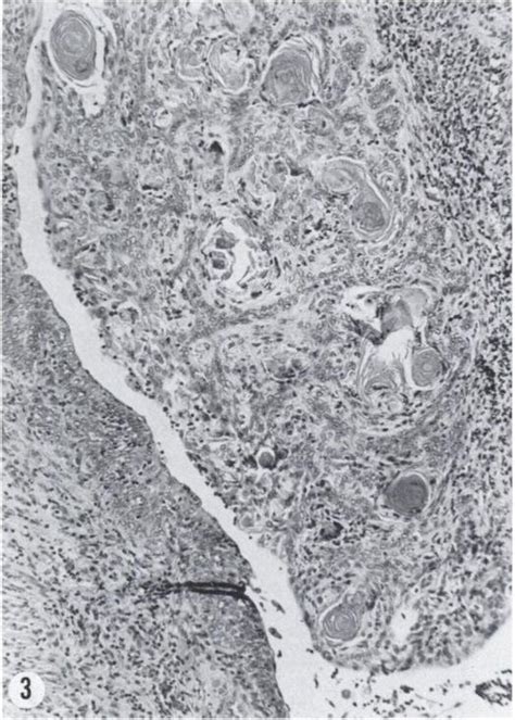 Small Squamous Cell Carcinoma Of The Uterine Cervix With Infiltration