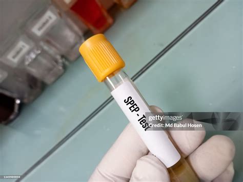 Blood Sample For Serum Protein Electrophoresis Test Medical Concept