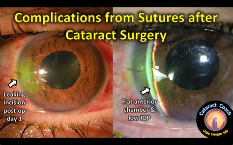 Suture Complications After Cataract Surgery Cataract Coach