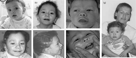 Midline Defects In Deletion 18p Syndrome Clinical And Molec Clinical Dysmorphology