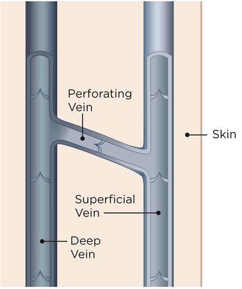 About Vein Disease | Alaska Vein Clinic