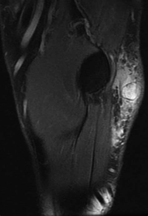 Imaging Features Of Myxoid Soft Tissue Tumours Clinical Radiology