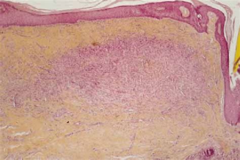 Histological Aspect Of Dermatofibroma The Lesion Is Overlaid By A