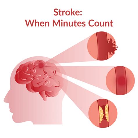 First Aid For Stroke Beaumont Emergency Hospital