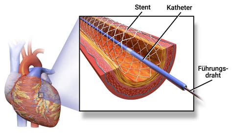 Stent Gründe Ablauf und Lebenserwartung praktischArzt