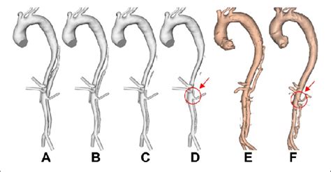 Evolution Of False Lumen Fl Surface In P2 Following Thrombus Growth