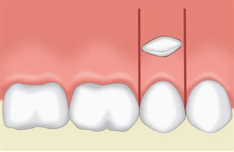 Flap Techniques In Dentoalveolar Surgery Intechopen