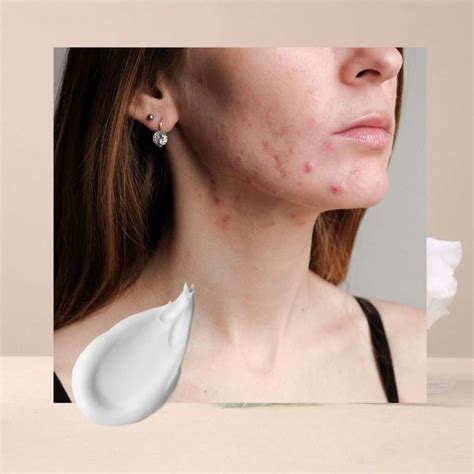 Treating Adult Acne And Acne Scars The Grand Medical Aesthetic Clinic